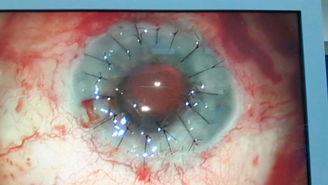 10.01.2018
Recep Tayyip Erdoğan Üniversitesi (RTEÜ) Eğitim Araştırma Hastanesinde ilk kez göz (kornea) nakli gerçekleştirildi.