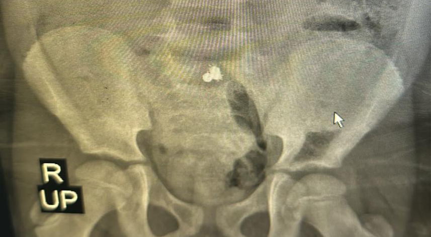 Rize'de küçük çocuk mıknatıslı topları yuttu, bağırsağı delindi