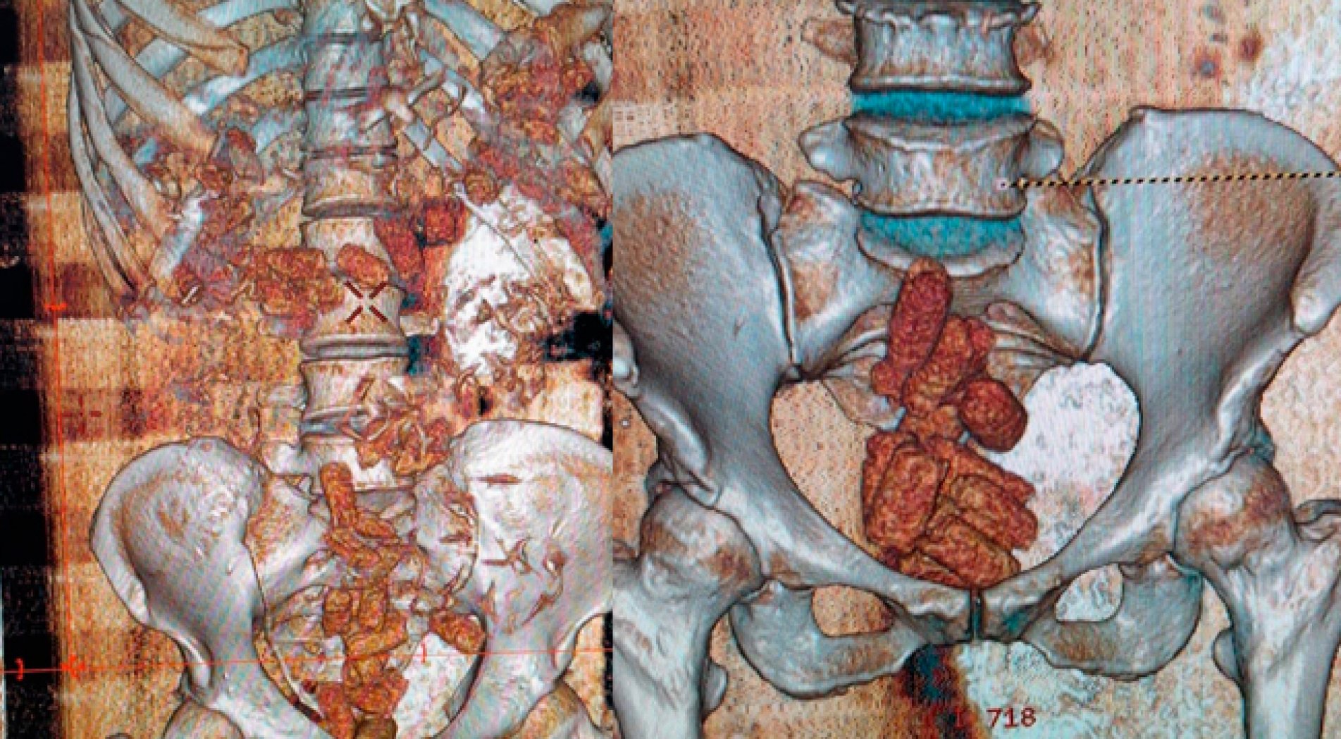 45-50 Kapsül Uyuşturucu Midelerinden Çıktı