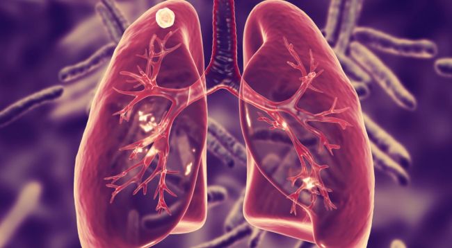 24 Mart Dünya Tüberküloz Günü