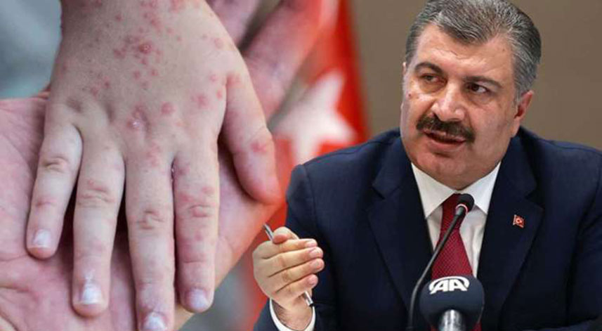 Kızamık vakasının en çok olduğu il açıklandı