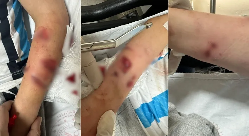 Rize'de 12 Yaşındaki Çocuğa Köpek Saldırdı