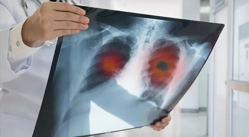 Türkiye'de yılda ortalama 41 bin kişi akciğer kanserine yakalanıyor
