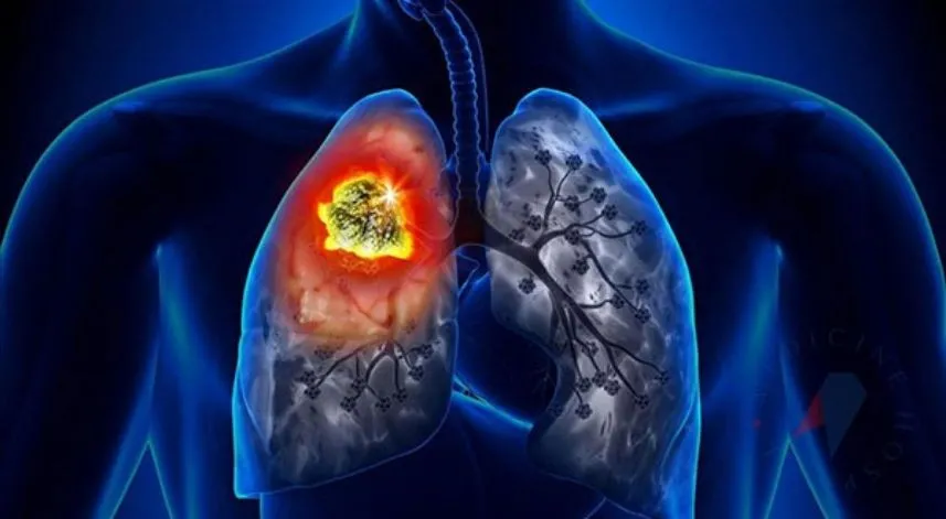 Kadınlarda akciğer kanseri vakalarında artış yaşanıyor