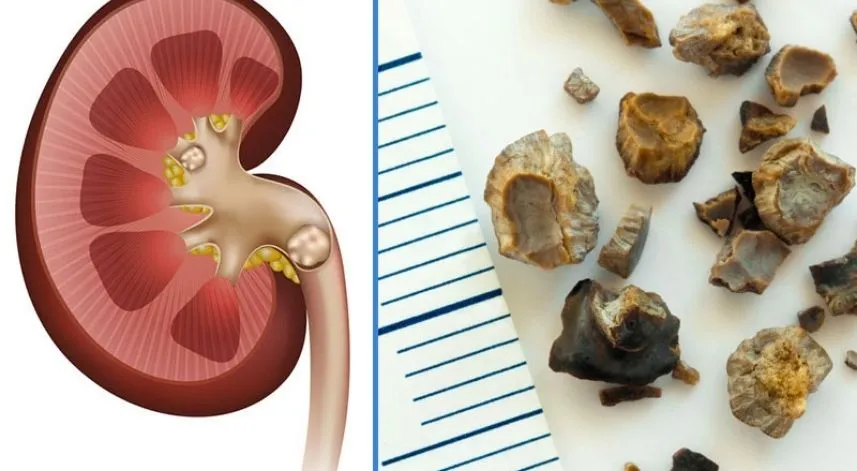 Uzmanı, böbrek taşı oluşumuna karşı alınması gereken önlemleri açıkladı