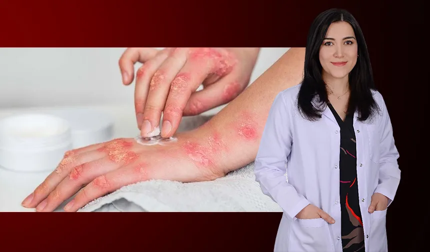 Uyuz vakaları yeniden artışa geçti