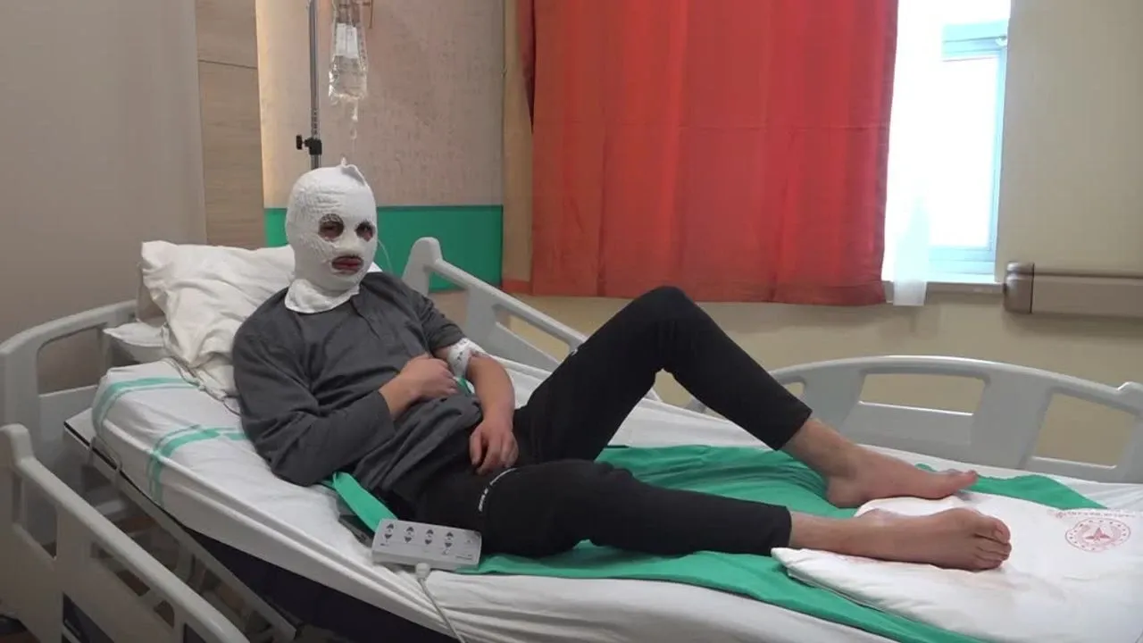 Çakmağına gaz doldurduğu tüpün patlamasıyla yüzü yandı