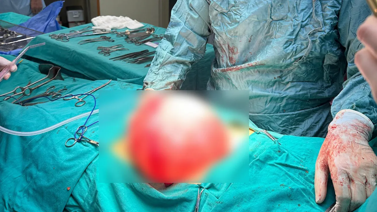 Kilolarından kurtulmak için doktora giden liseli kızın karnından 3,5 kilo ağırlığında kist çıktı